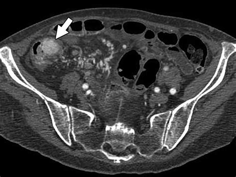 Multimodality Imaging Of Ileal Neuroendocrine Carcinoid Tumor Ajr