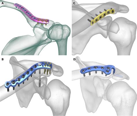Surgical Treatment Of An Unstable Distal Clavicle Fracture