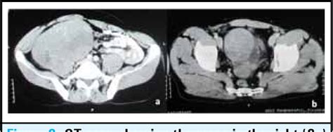 Figure 3 From Bilateral Synchronous Testicular Seminoma In A Patient