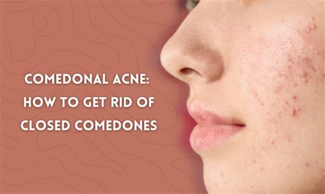 comedonal acne    rid  closed comedones skin beauty
