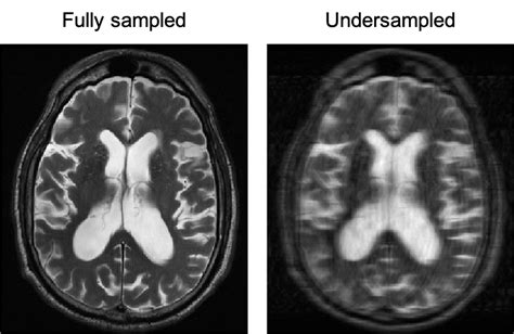 Nyu Langone Center Increases Mri Accessibility Through Cooperative Data