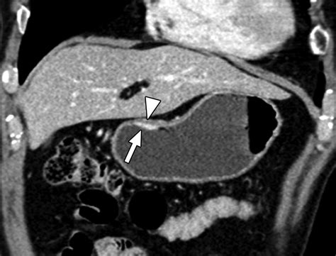 Three Dimensional Mdct For Preoperative Local Staging Of Gastric Cancer Using Gas And Water