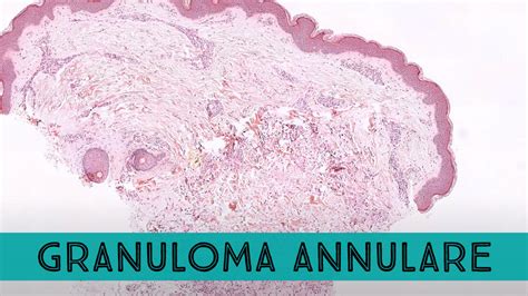 Granuloma Annulare Video Kiko Xp