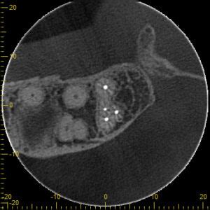 Minimally Invasive Endodontics With Laser Activated Irrigation