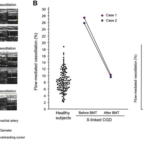 Dihydrorhodamine Assay On Flow Cytometry In A Normal Control 1 And A