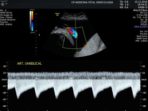 Ultrassonografia Obst Trica Dopplerfluxometria Cr Medicina Fetal