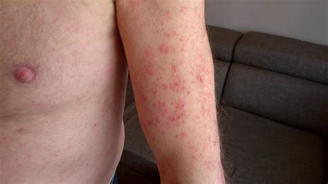 Skin Rash Covid Wysypka Sk Rna Youtube