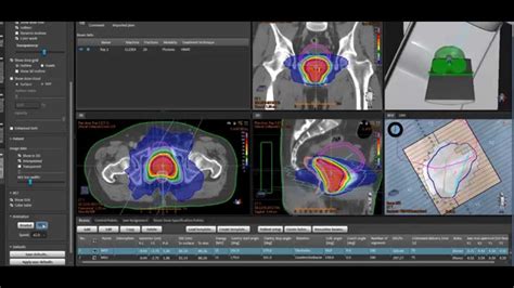 Volumetric Modulated Arc Therapy VMAT YouTube