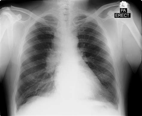 Mediastinal Mass – UNI CLINIC