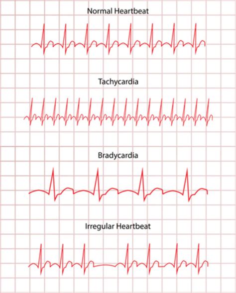 How To Perform Ecg Categorization And Detect Arrhythmia Knime