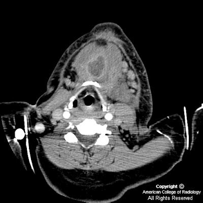 Neuroradiology On the Net: Floor of the mouth abscess causing early ...