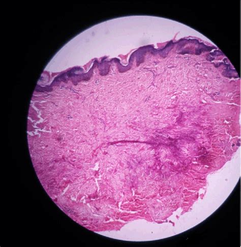 Skin Histopathology Showing Hyperkeratosis Of The Epidermis With Loss