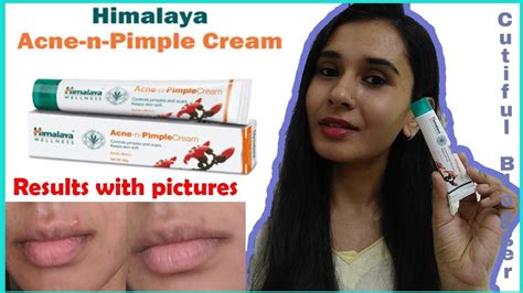 Himalaya Wellness Acne N Pimple Creampack Of 2 Ubicaciondepersonas