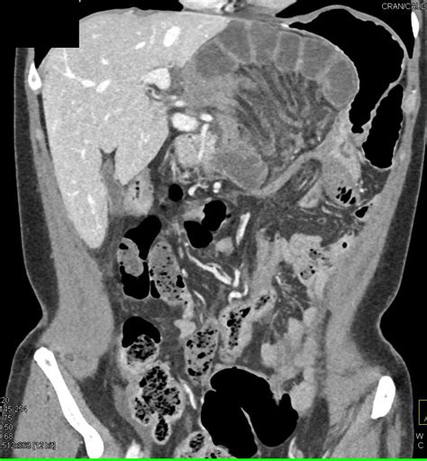 Internal Hernia With Midgut Volvulus With Small Bowel Obstruction And Ischemic Bowel Small