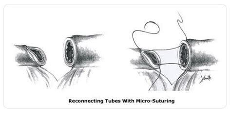 What is Tubal Reversal Surgery or Anastomosis? | NCCRM