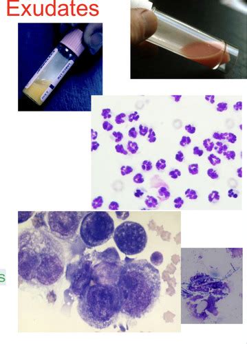 Clinical Pathology Specific Cavitary Effusions Flashcards Quizlet