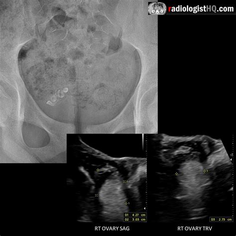 Right Ovarian Dermoid Cyst With Teeth On X Ray R Radiology