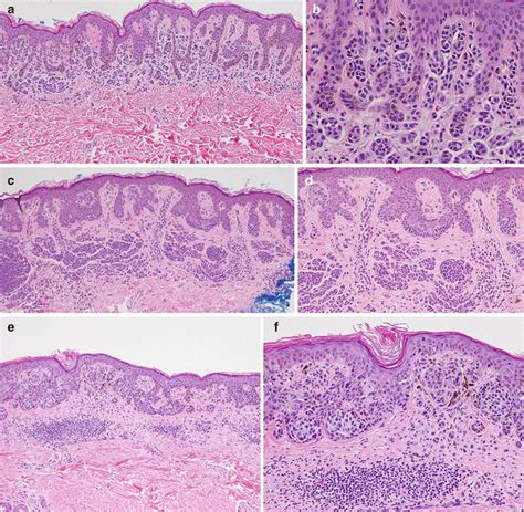 Dysplastic Nevus Histology