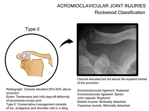 Acromioclavicular Joint Injuries Illustrations International Porn Sex