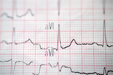 Un electrocardiograma ECG un gráfico que dibuja la electricidad del