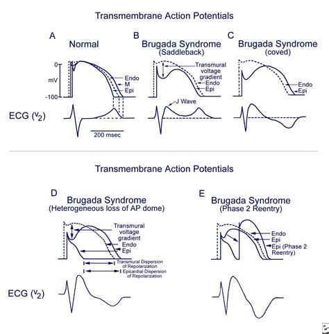 Brugada Syndrome Brugada Syndrome Cardiology Syndrome