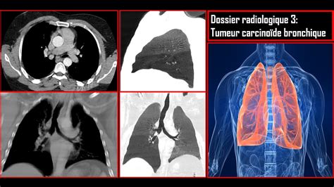 Dossier radiologique 3 Tumeur carcinoïde bronchique YouTube