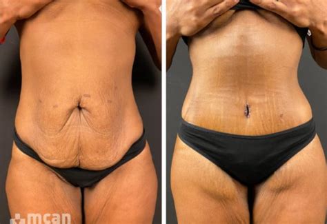 Tummy Tuck Turkey Abdominoplasty Cost Of 2023 MCAN