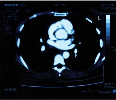 Spiral CT scan image showing normal lung vas- culature. | Download Scientific Diagram