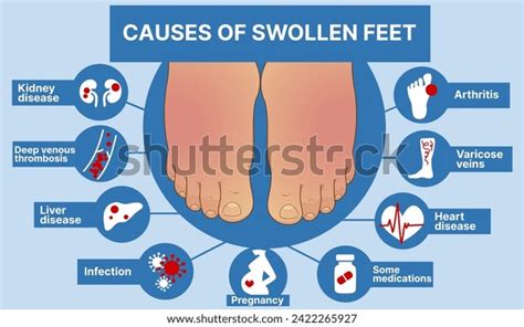 Causes Swollen Feet Healthcare Infographic Educational Stock Vector