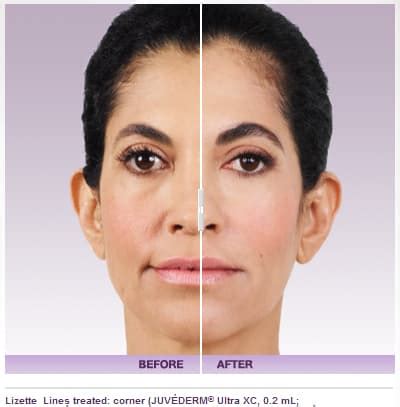 Juvederm Injectable Filler Before and After Photos | Los Angeles | Pasadena