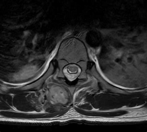 Recognizing And Managing Epidural Abscess Emra