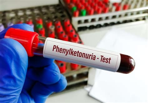 Premium Photo Blood Sample For Phenylketonuria Pku Test