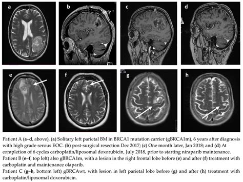 Radiological Responses Of Three Patients With Bm On Parpi Therapy