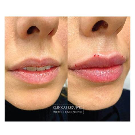 Transforma Tus Labios Con Cido Hialur Nico Mira El Antes Y Despu S