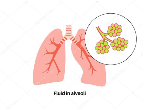 Infección por neumonía póster anatómico Inflamación en el sistema