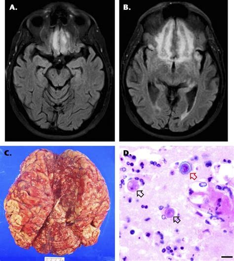 A Initial Mri Of Brain At Onset Of Symptoms Of Encephalitis Showing