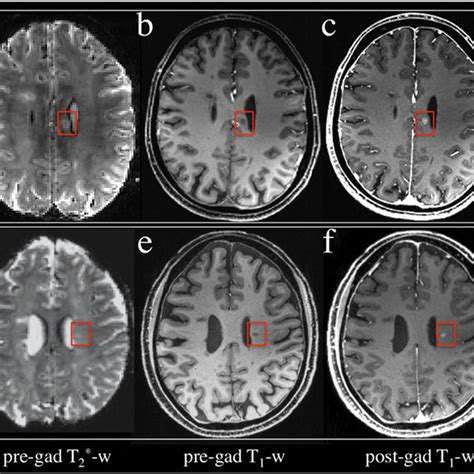 Brain Mri Showing Lesions