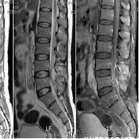 Two Weeks After Admission Follow Up Magnetic Resonance Image Was