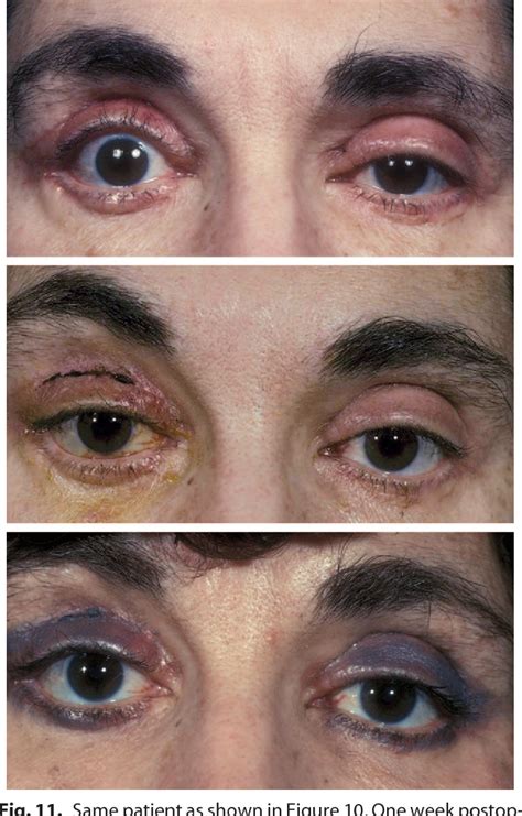 Figure 8 From Blepharoplasty Complications Semantic Scholar