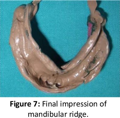 Figure From Prosthodontic Management Of A Patient With Limited Mouth