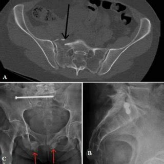 Fracture Branche Ilio Et Ischio Pubienne Kirbybedenbaughs