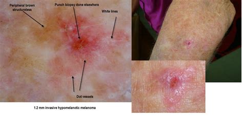 Dermoscopy Made Simple Melanoma In Situ Mainly