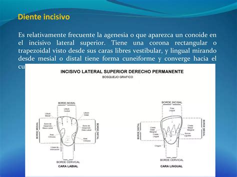 Caras Del Diente Incisivo Lateral Superior