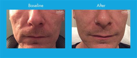 Bellafill Treatment For Acne Scarring In New Jersey Soma Skin Laser