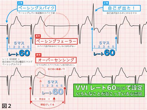 心カテまるわかり｜心カテ室で使われるME機器～テンポラリーペースメーカー③～｜心臓のはなしをしましょうか｜＃035｜野崎暢仁 | 心臓のはなし ...