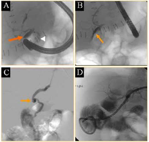 Aandb Ercp Demonstrating Bile Leakage From Chd Arrow In A And Download Scientific Diagram