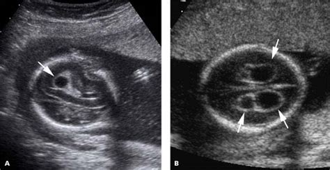 Choroid Plexus Ultrasound