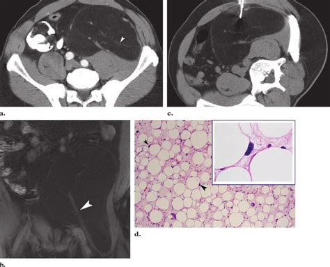 Well Differentiated Liposarcoma A Ct Scan Shows A Large Left