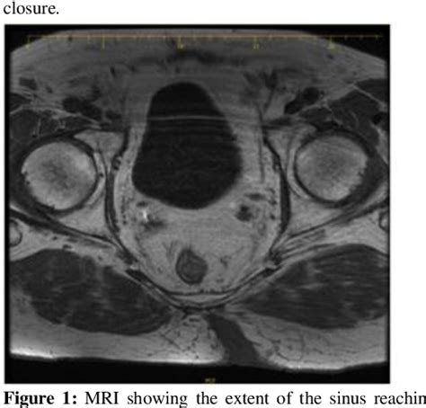 Figure 1 From Management Of Squamous Cell Carcinoma In A Chronic Sacrococcygeal Pilonidal Cyst