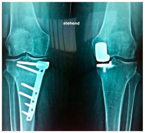 Jcm Free Full Text Unicompartmental Knee Arthroplasty Provides